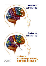epilepsy_seizure